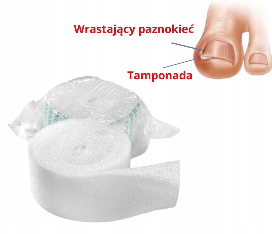 Wrastające paznokcie tamponada Ligasano w rolce