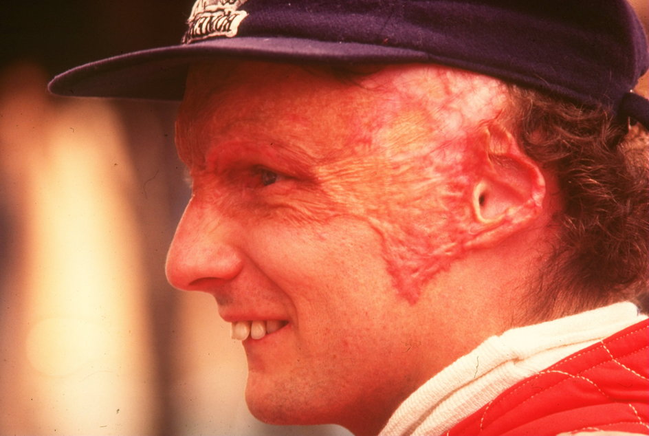 Niki Lauda po wypadku