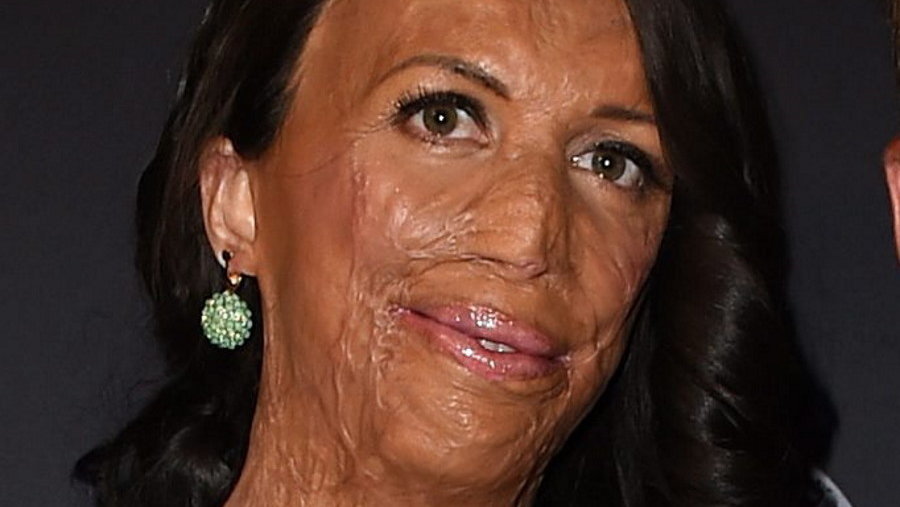 Turia Pitt