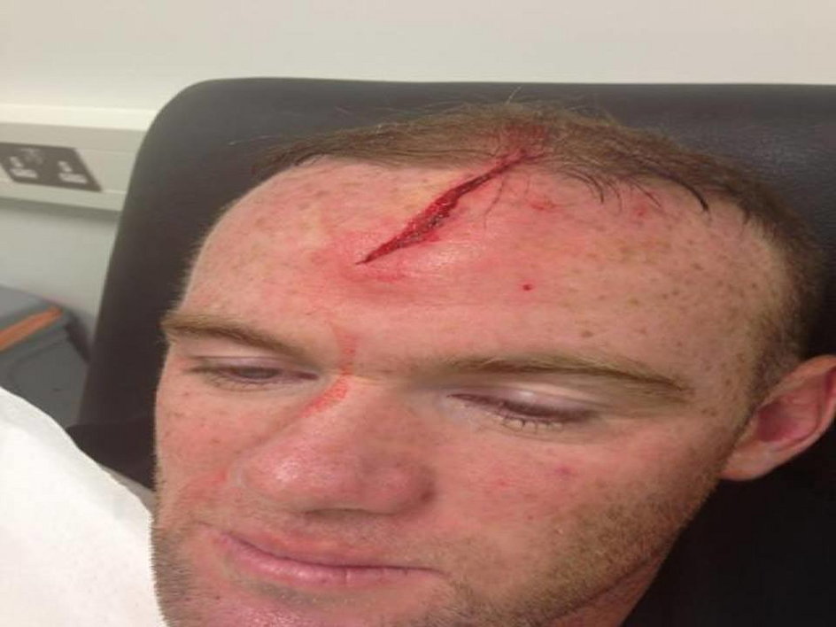 Wayne Rooney chwali się dziurą w czole