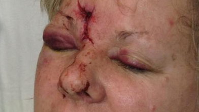 Kobieta dostała krążkiem w twarz - trafiła do szpitala