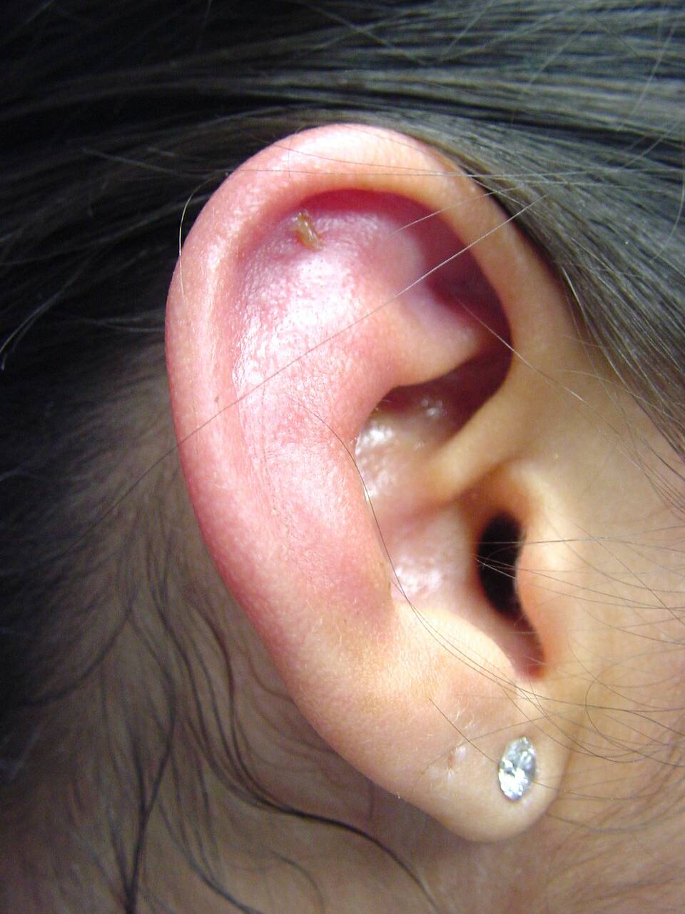 Auricle_Perichondritis_May29_2003_004.jpg