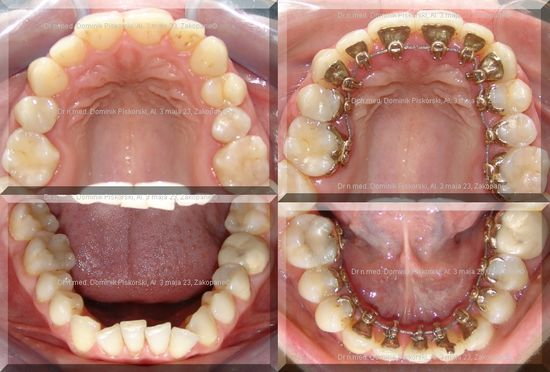 Krzywe zęby po zdjęciu aparatu ortodontycznego