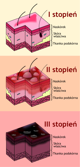 275px-Burn_Degree_Diagram_pl.svg.png