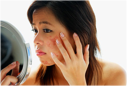 getty_rf_photo_of_asian_woman_with_acne.jpg