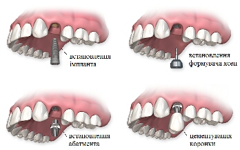 implant wkręcany w kość żuchwy